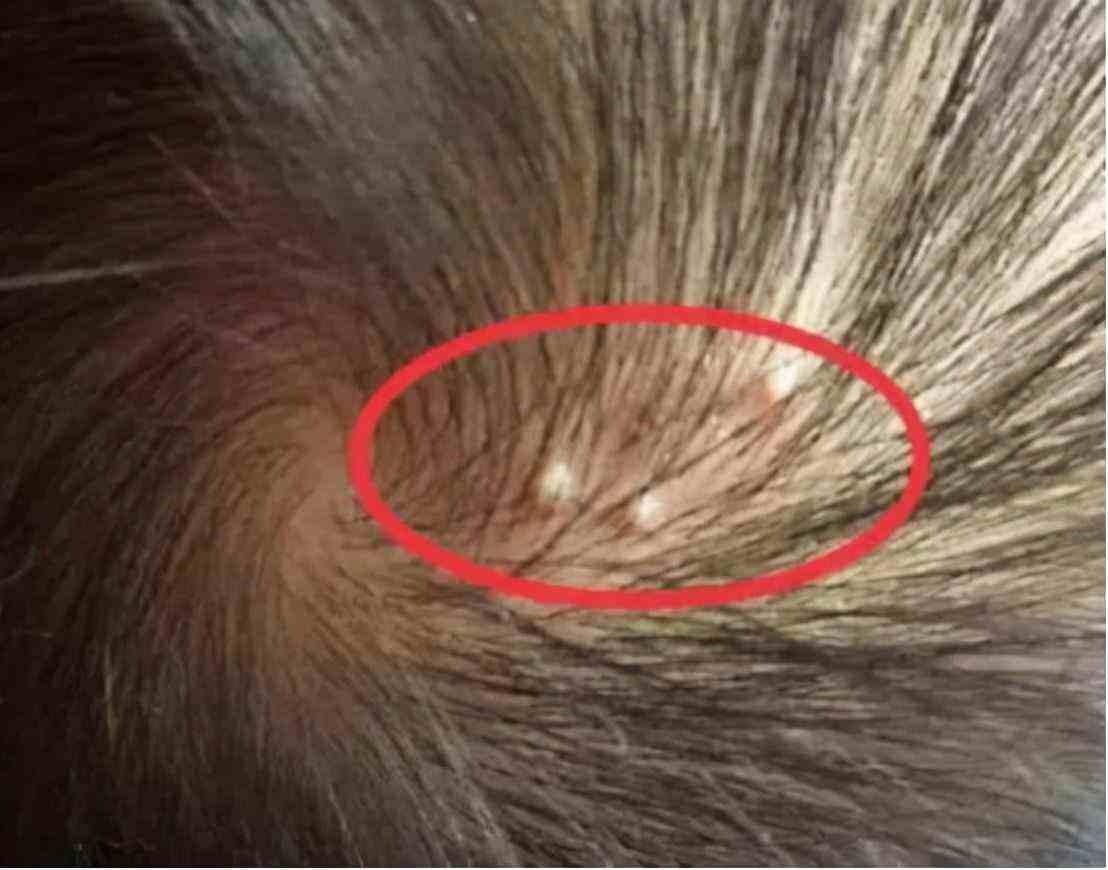 为什么头皮上有小疙瘩和脓包,头皮长疙瘩和脓包是怎么回事
