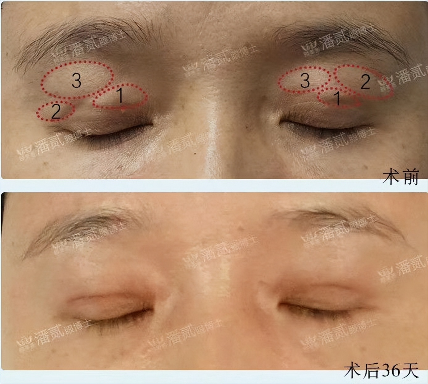 埋线双眼皮如果不满意怎么修复,切开双眼皮失败可以用埋线修复吗