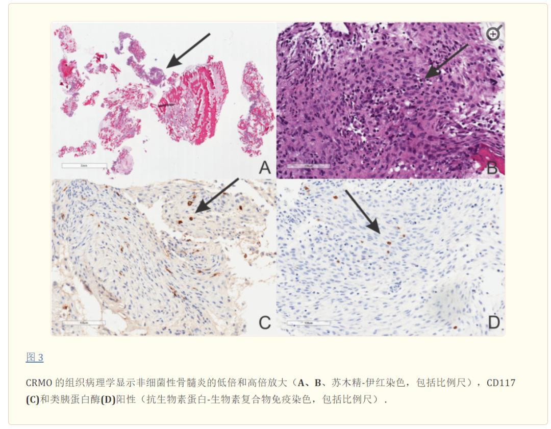 慢性骨髓炎症状,慢性复发性多灶性骨髓炎