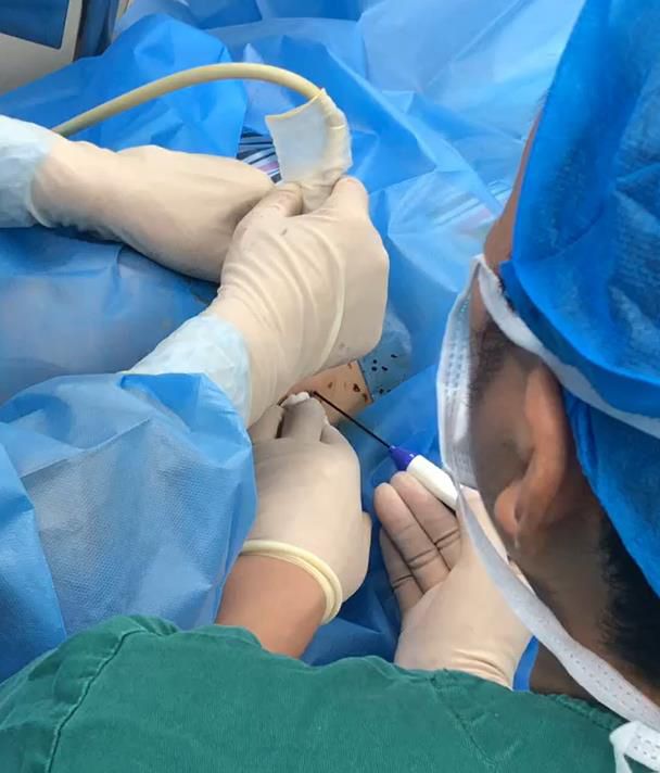 深圳甲状腺肿大怎么治疗?正康医院微波消融