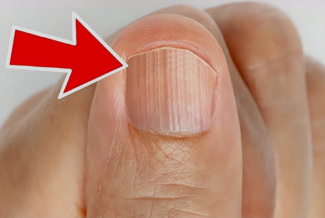 手指有竖纹是肝不好的表现吗,手指甲竖纹没有月牙是肝不好么