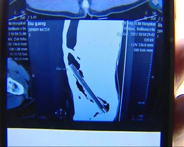 山东小伙被捅19刀凶手是谁,山东23岁小伙被捅19刀