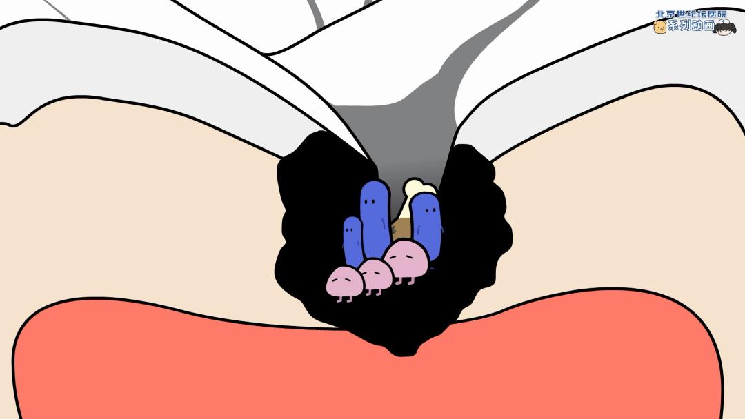 健康科普龋齿窝沟封闭,预防蛀牙科普视频