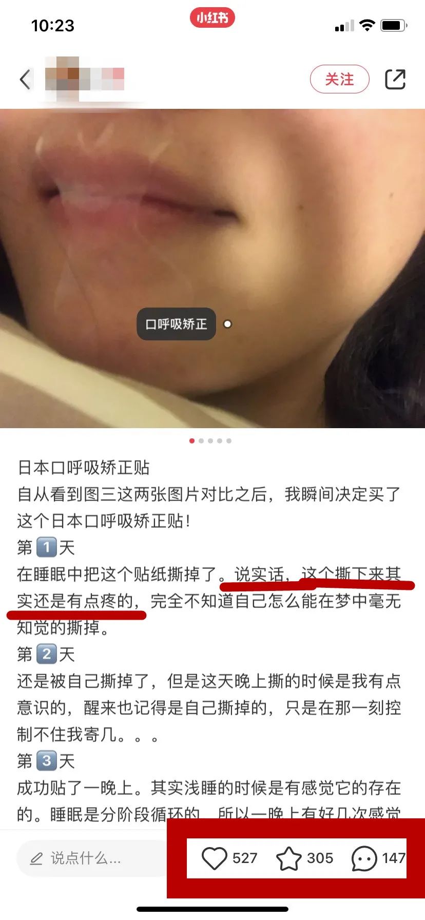 口呼吸矫正最佳方法不用呼吸贴,口呼吸贴嘴