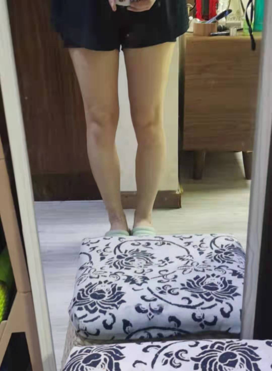 o型腿案例,宝妈o型腿