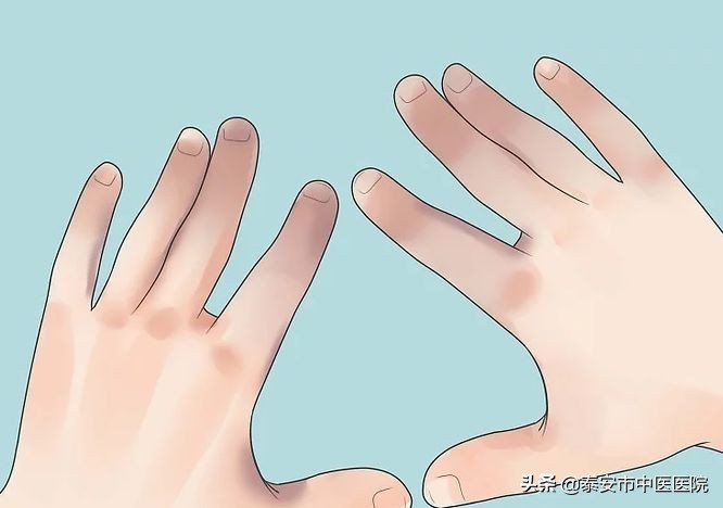 中医治冻疮特效验方,中医冻疮