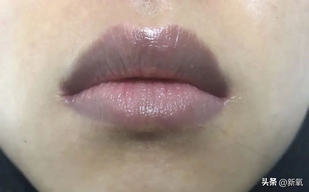 嘴唇薄变丰满,嘴唇变凸变丑怎么办