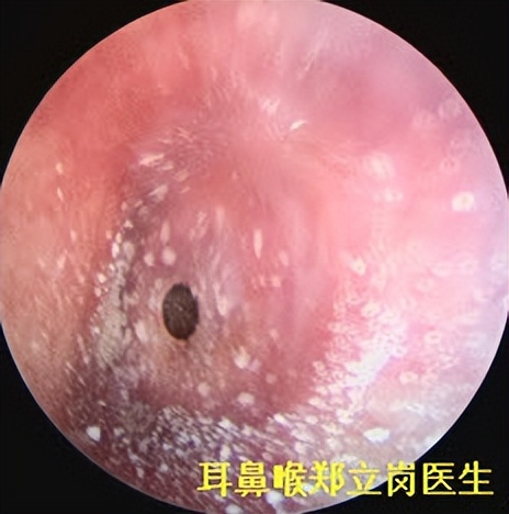 慢性中耳炎耳膜穿孔灌脓了怎么治,中耳炎引起鼓膜炎怎么办