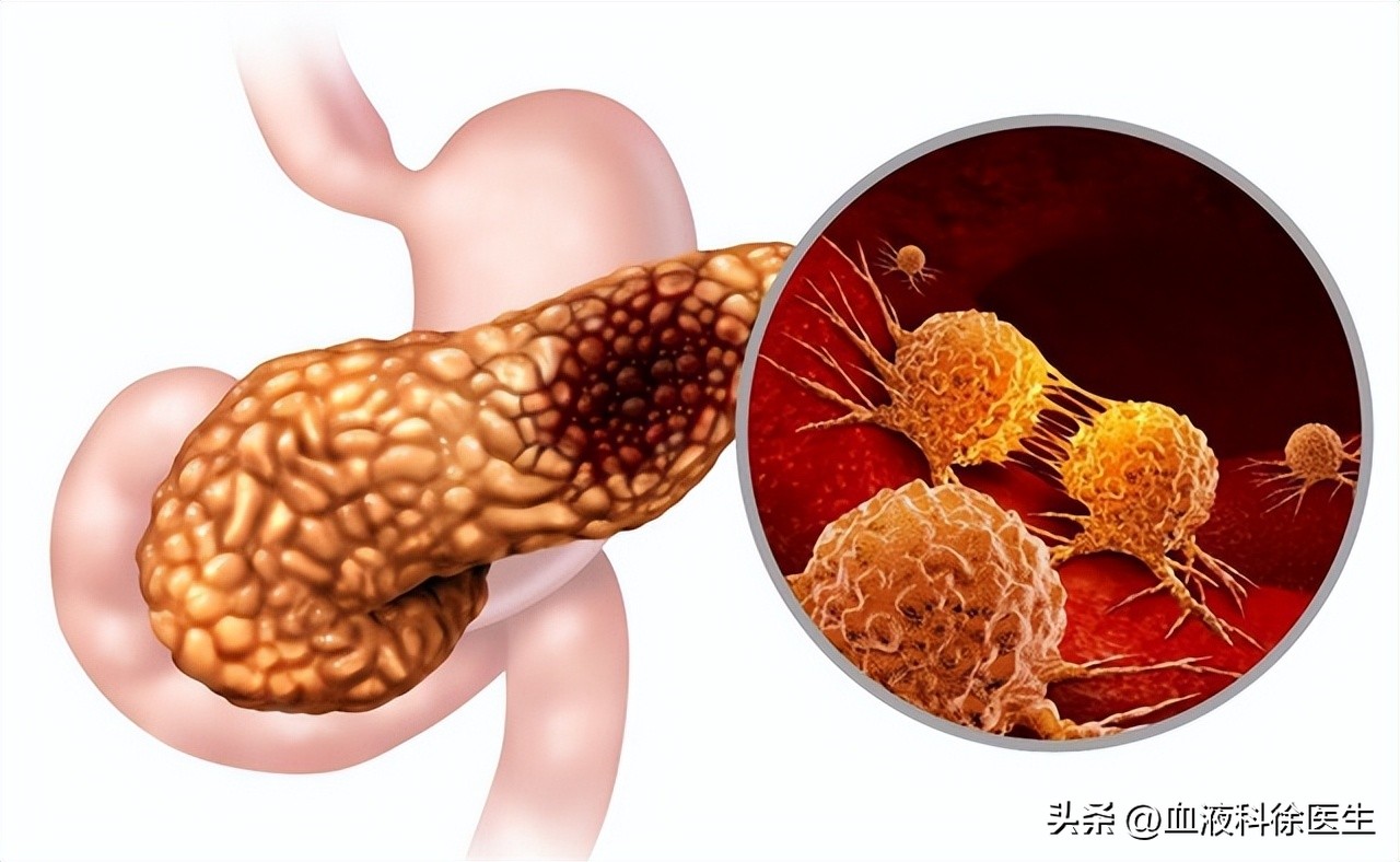 得了胰腺癌真的无药可救了吗,如果得了胰腺癌还能活多久