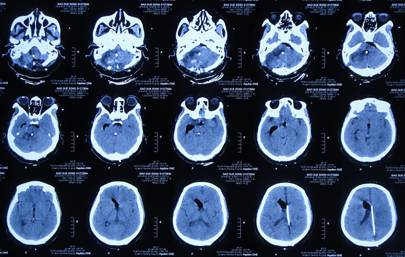 听神经瘤出现脑积水和出血,听神经瘤手术后颅压高症状