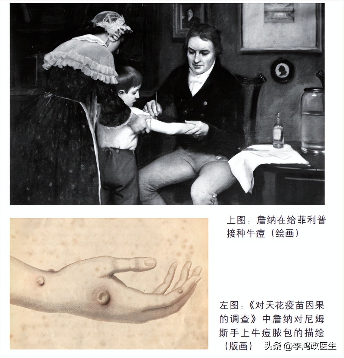 天花病为什么奇迹般消失了,对天花没有免疫力