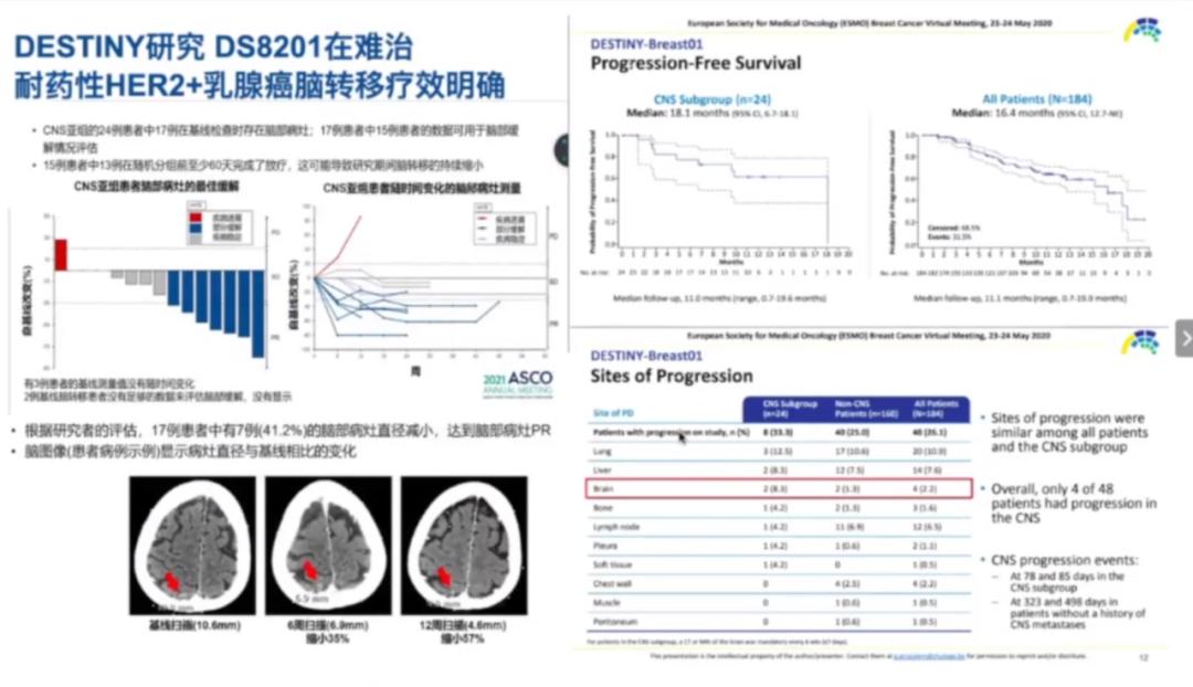 her2乳腺癌免于化疗吗,乳腺癌2030