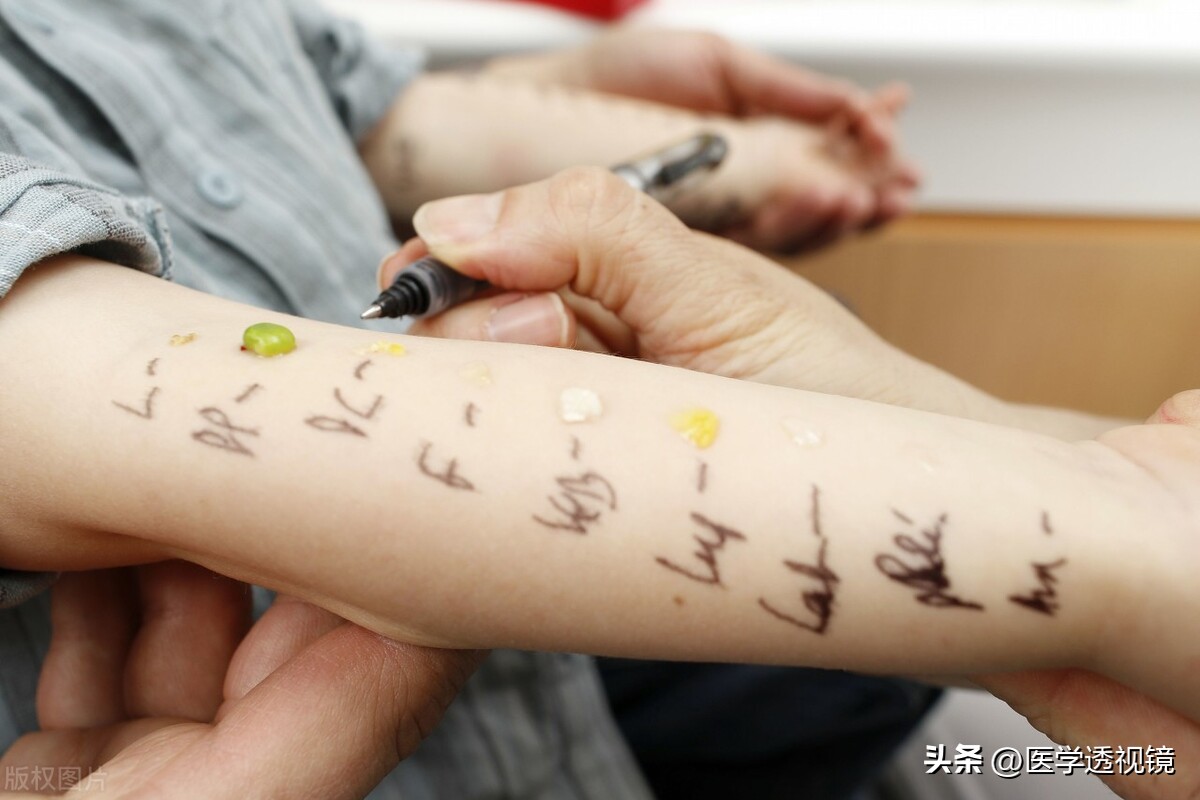 常吃东西过敏,哪些食物易引起食物过敏