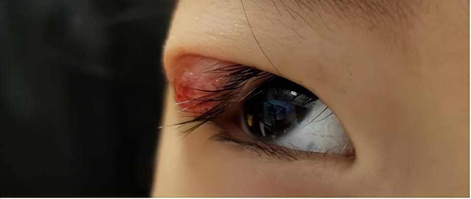 孩子长了针眼红肿出头了怎么处理,小儿针眼起脓包怎么办