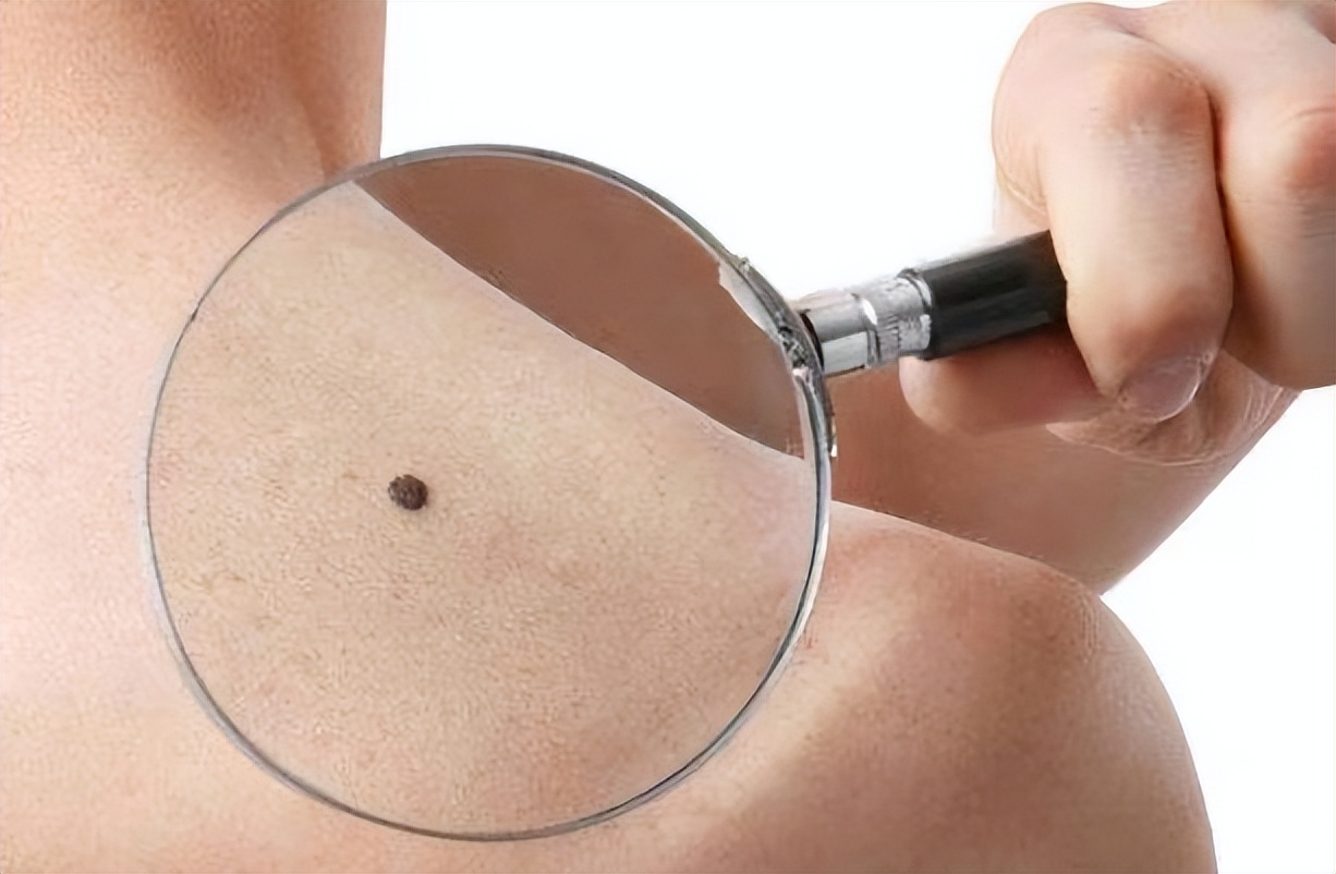 右脸上的痣要不要点掉,脸上的痣不能乱点的说法