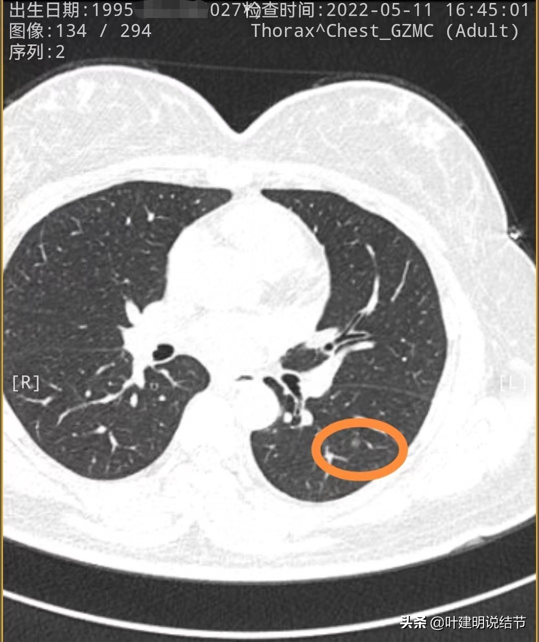 27岁女博士查出肺癌,年轻人多发肺结节怎么治愈