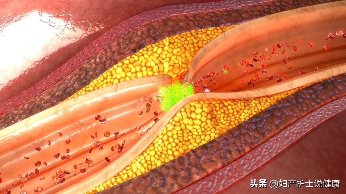 男人到底该不该穿长筒袜,做什么手术要穿弹力袜