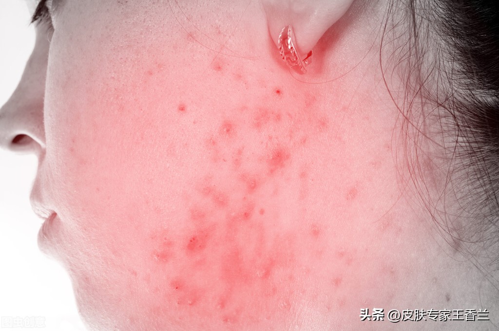 出油毛孔粗大长痘痘怎么改善,皮肤长痘油腻毛孔粗大怎么改善