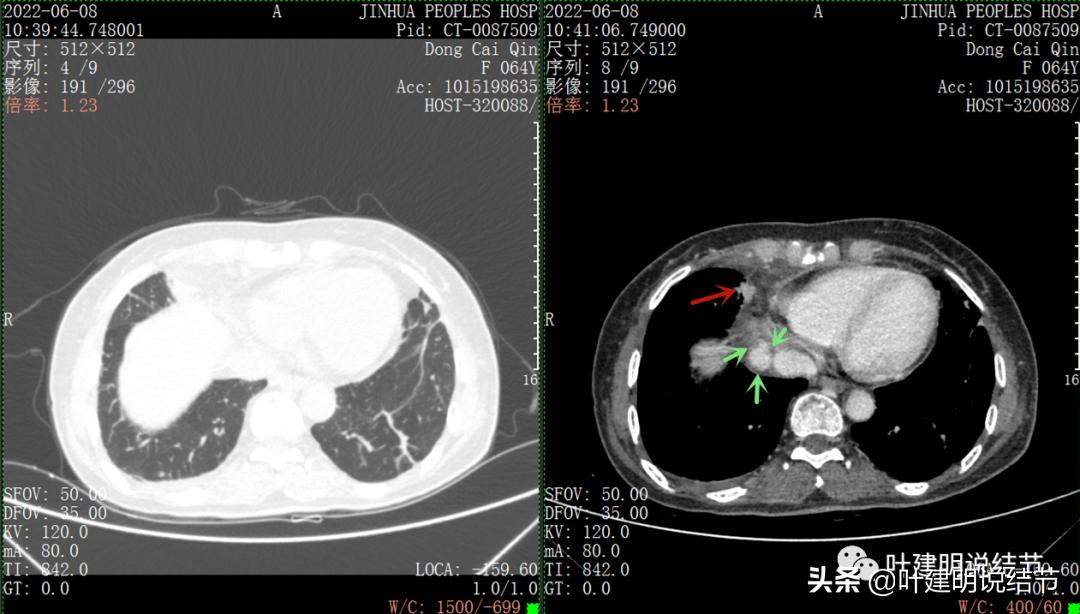这位老乡，乏力来查，查出这么大个的纵隔肿瘤！会是什么呢？
