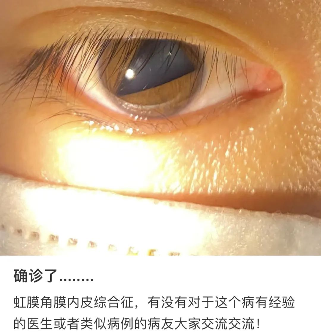 瞳孔分裂成心形是什么症状,瞳孔突然变成三角