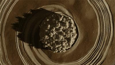 肿瘤碘125粒子植入术图片,碘125粒子植入术治疗胰腺癌