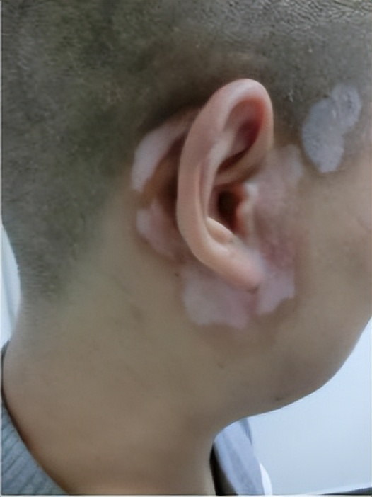 白癜风治愈的最佳方法,白癜风做308分子激光能彻底治愈吗