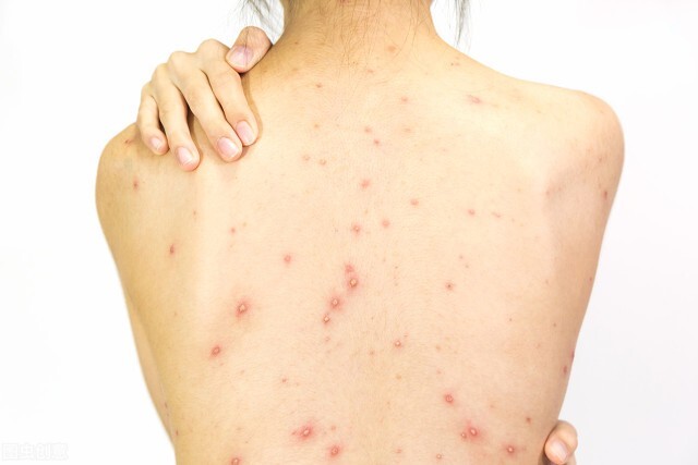 胸口背部长痘痘是什么原因,女孩背部长痘痘是什么原因