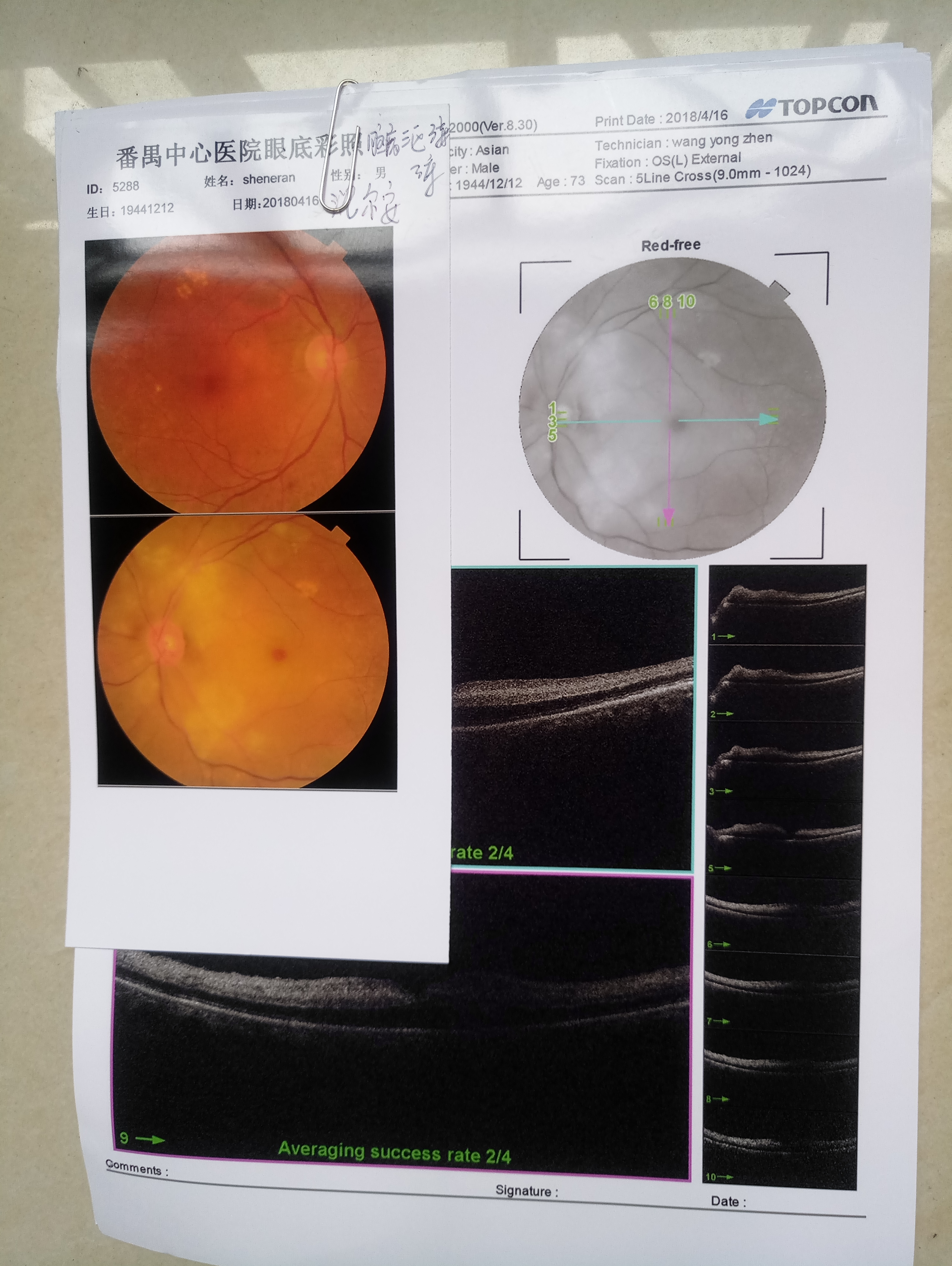 亲人突发脑梗死亡的遗憾,父母离别的伤痛