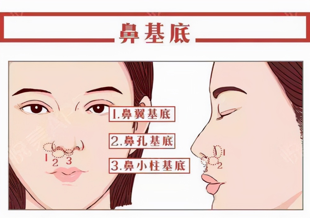 玻尿酸填充鼻基底和假体隆鼻,玻尿酸填充鼻基底效果怎么样