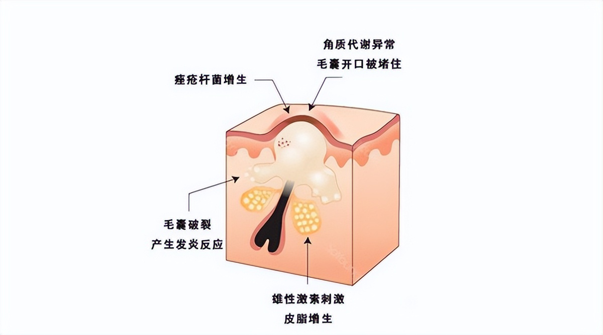 突然长很多痘痘中医如何调理,长期长痘痘怎么中医调理