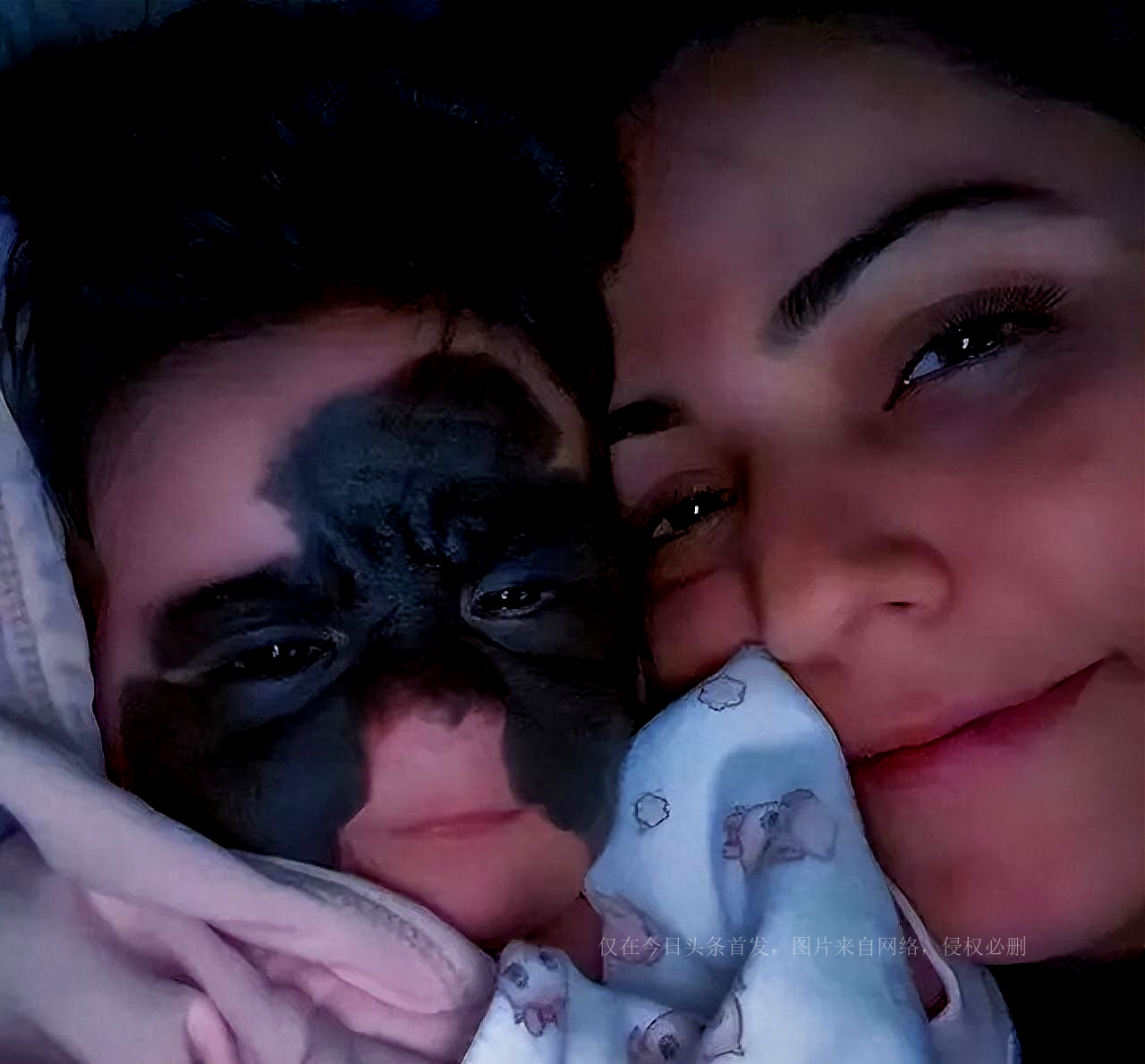 还记得天生胎记酷似“蝙蝠侠”的女婴吗？6次整容后，仍需治疗