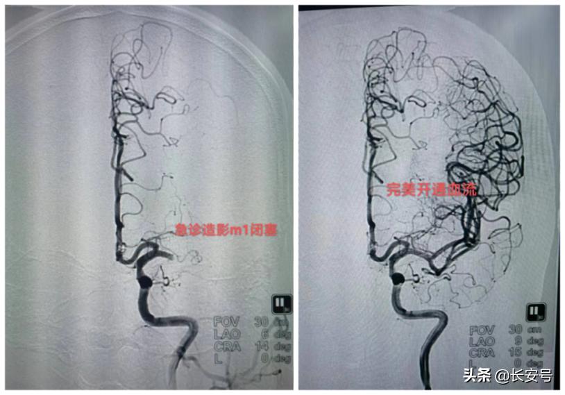 西安脑卒中,西安凤城医院预防保健科