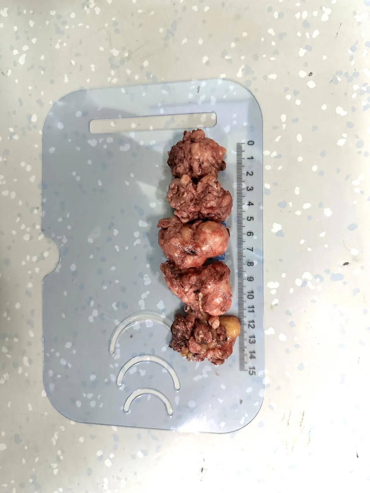 介入治疗前列腺增生效果怎么样,超微创手术治疗前列腺增生