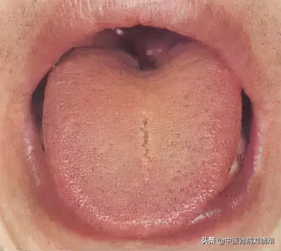 刘主任让病人伸舌头，看的是什么？
