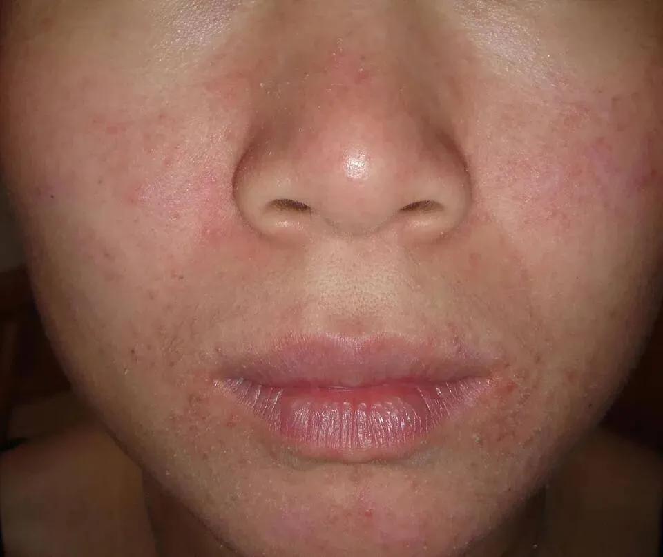 小孩身上抓破皮擦什么好,宝宝皮肤抓破皮有些感染怎么处理