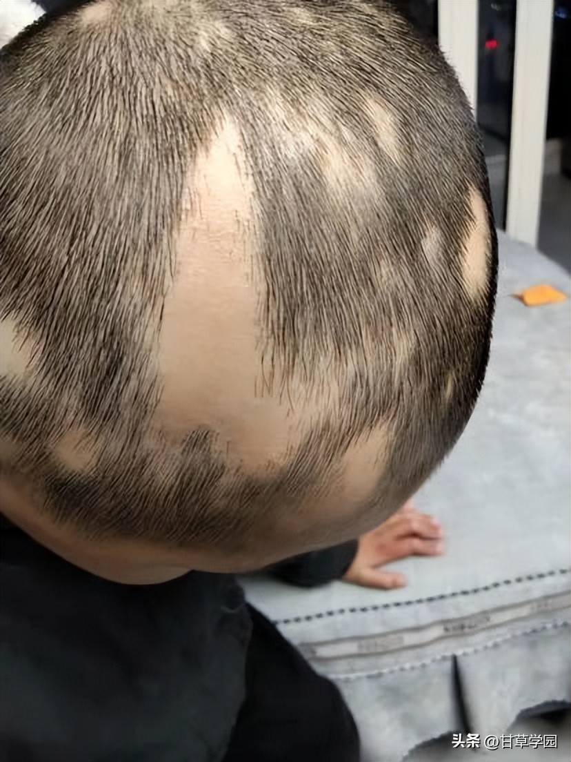 复方甘草治疗斑秃,甘草煮水治疗斑秃效果好吗