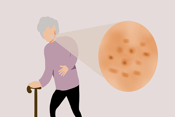 怎样用牙膏洗脸才能去除老年斑,牙膏涂抹治老年斑吗