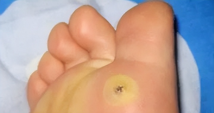 脚底板爱进风什么原因,脚底板走路磨起茧子怎么去