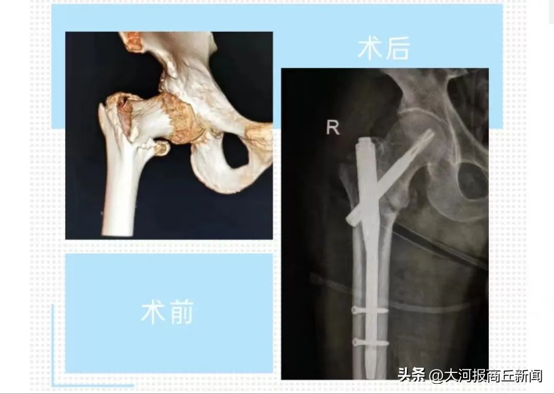 骨科医生腓骨骨折复位固定成功,骨科切开复位内固定