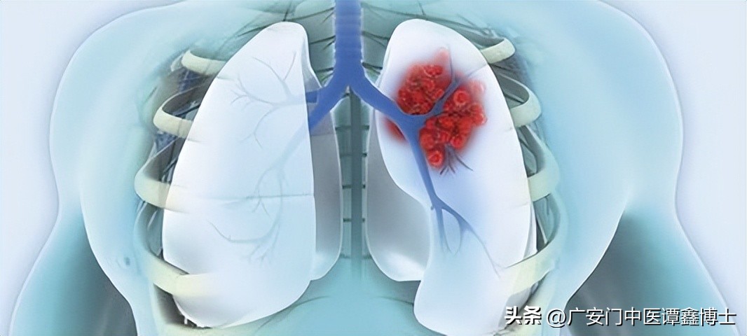 肺部肿瘤增大快属于什么类型肺癌,肺部肿瘤和肺癌的区别和危害