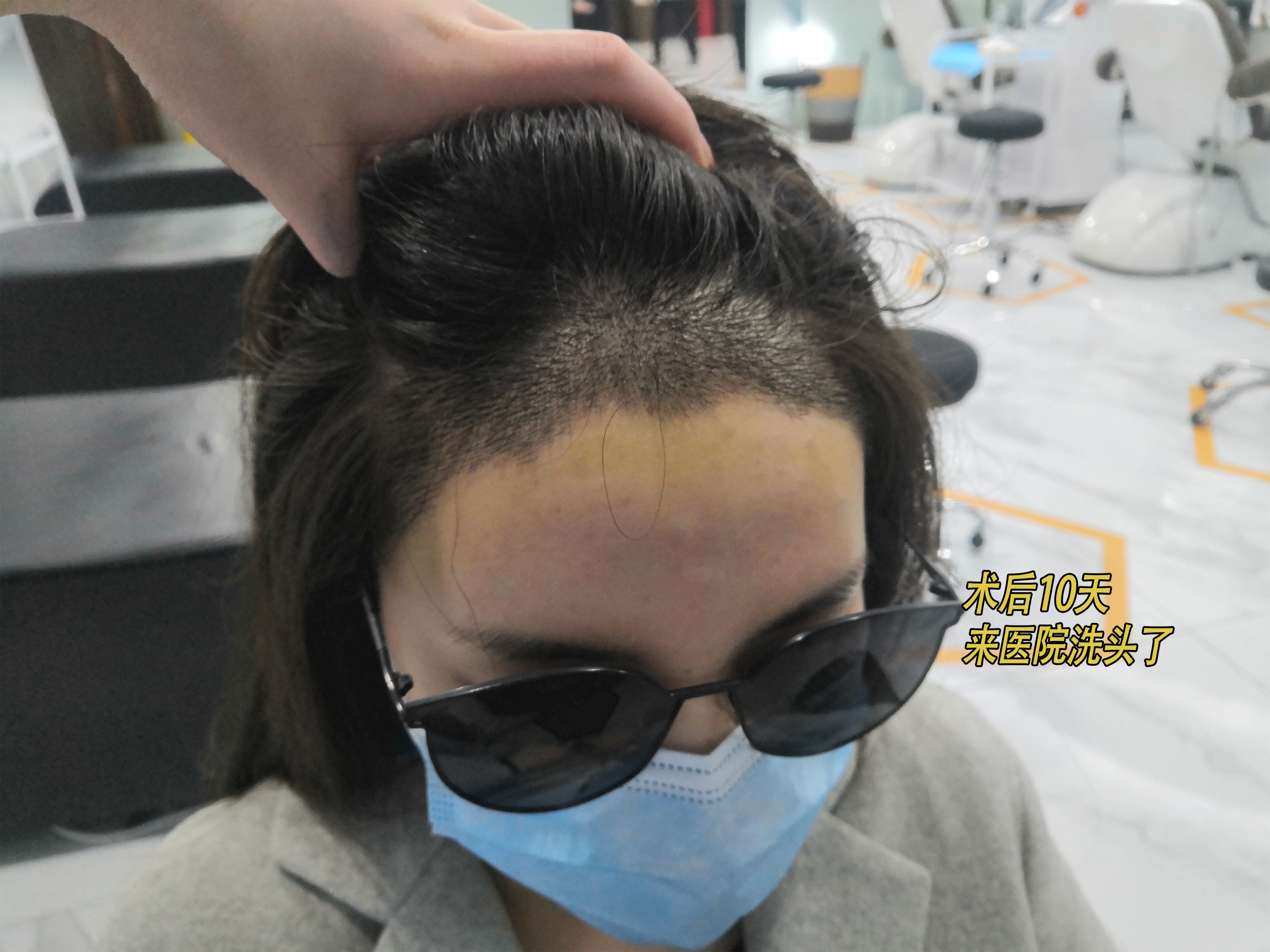 恒美植发后续,恒美植发靠谱不