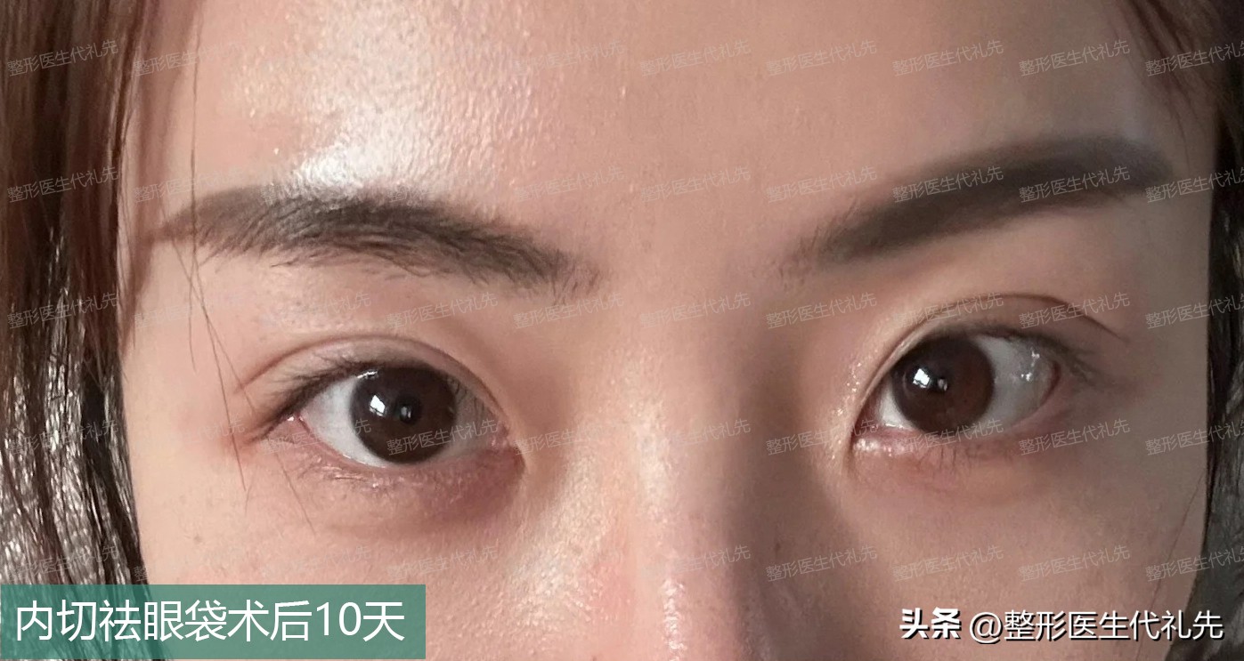 眼袋内切手术后眼袋不对称,年轻人内切眼袋手术恢复期7天图
