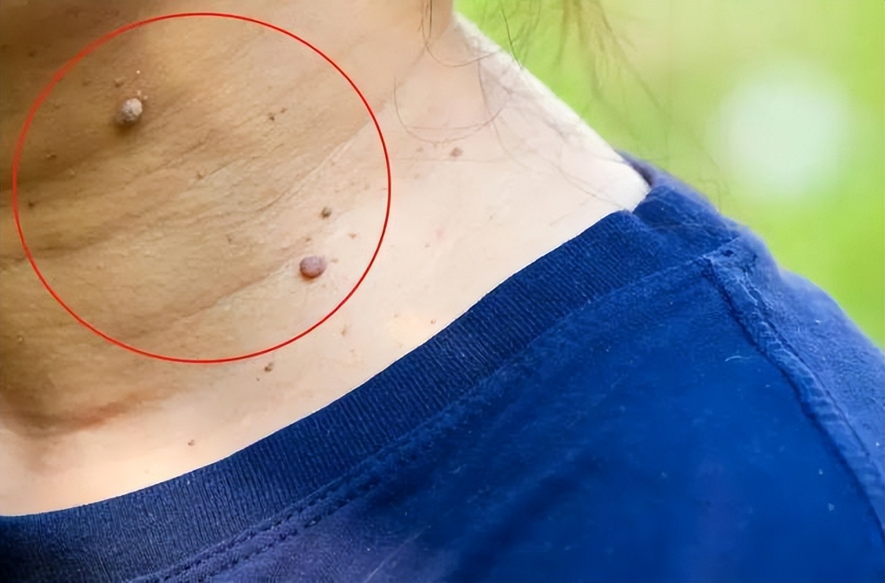 脖子腋下长小肉粒什么原因引起的,脖子上和腋下长小肉粒是什么原因