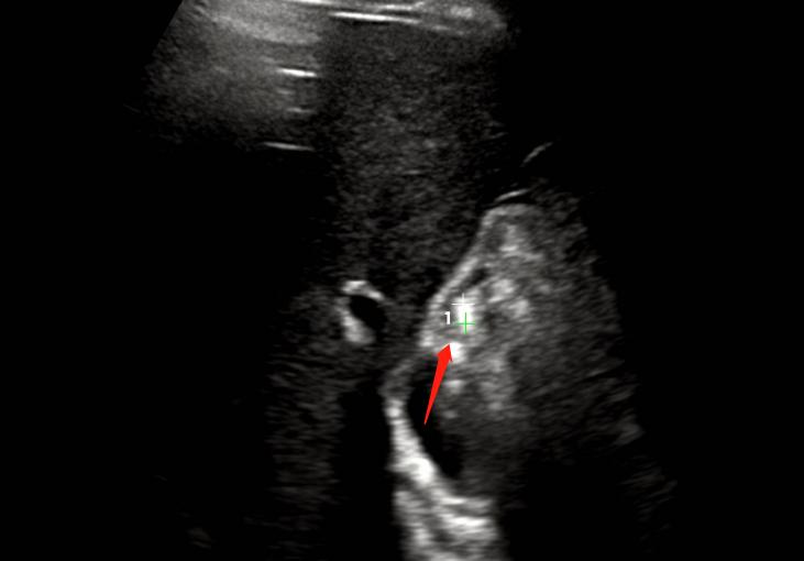 超声所见正常范围准确吗,超声看不清楚