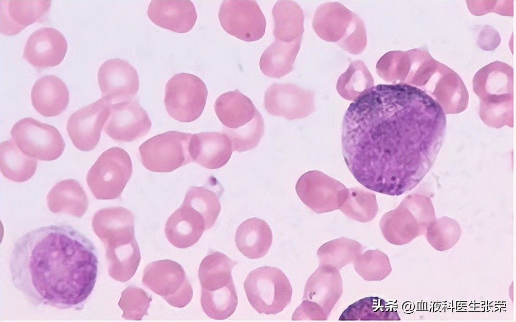 再障血小板低怎么才能升上去,再障患者血小板不长怎么办