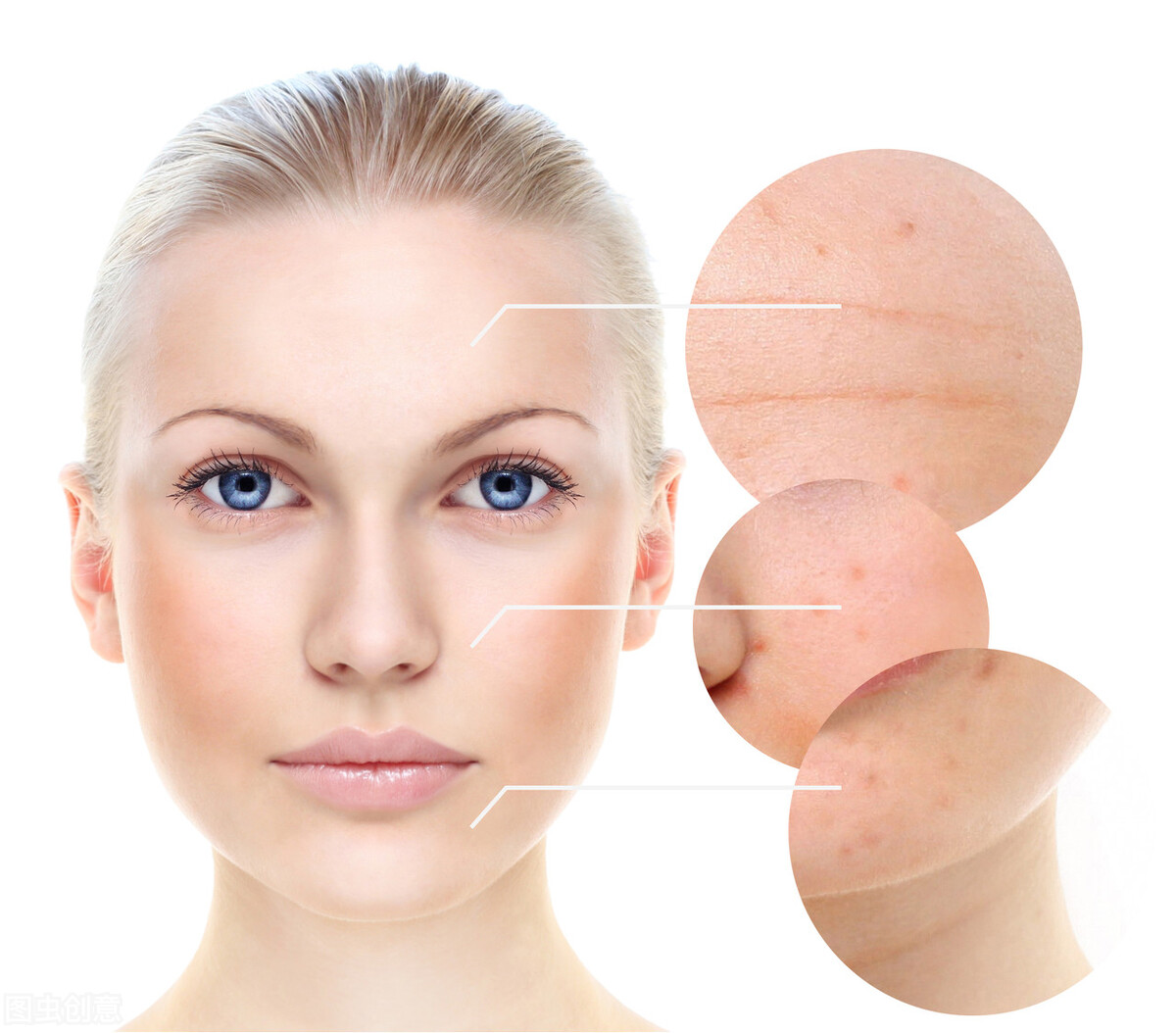 u区毛孔粗大是哪种类型,u型毛孔怎么改善