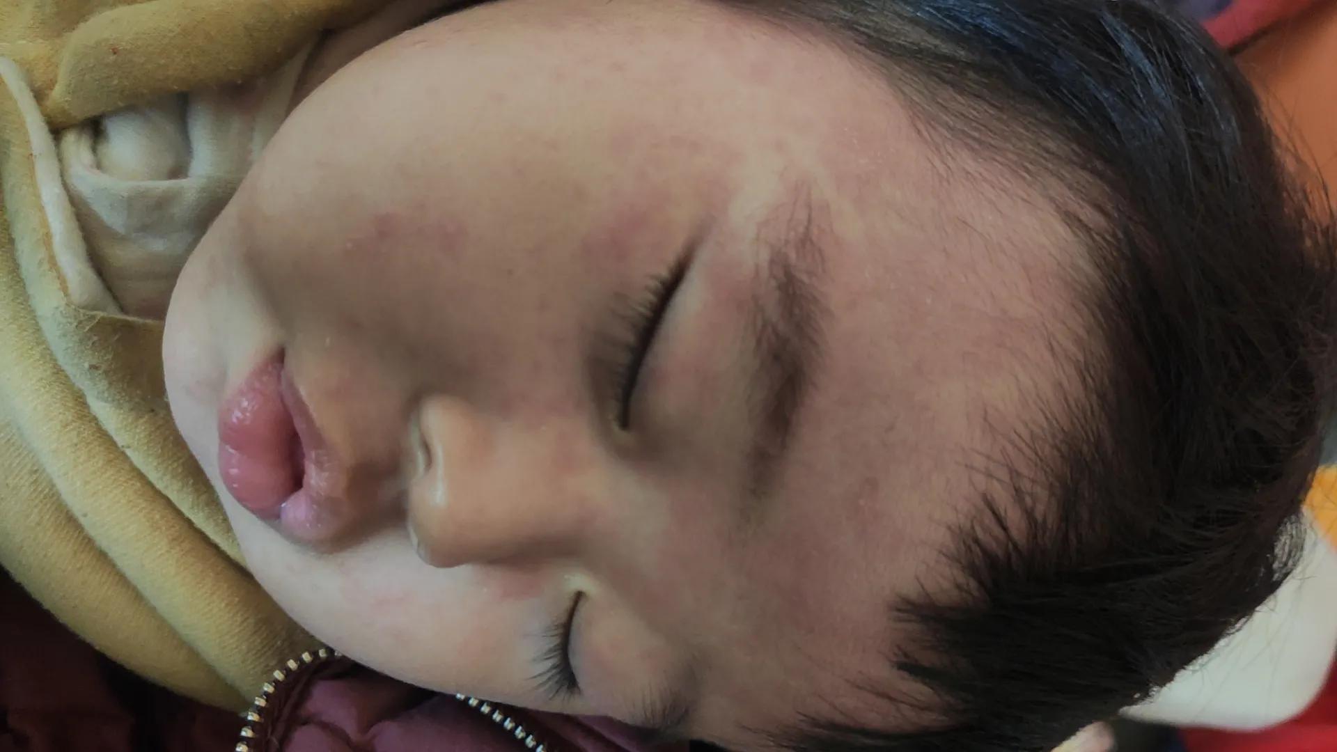 幼儿玫瑰疹的症状,玫瑰疹是幼儿急疹吗