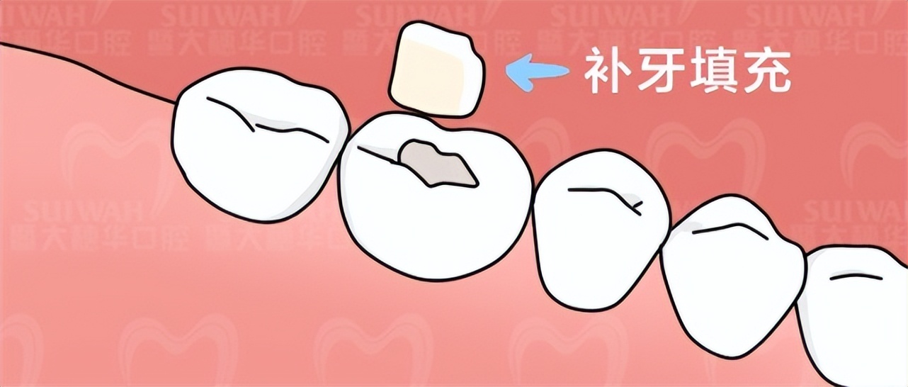 补牙后多久吃饭对牙修复更好,补牙后多久才能吃东西