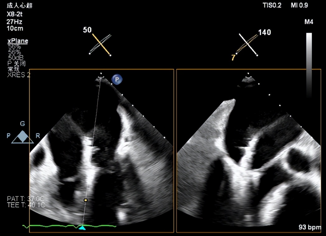郑州大学第一附属医院心脏瓣膜,新技术治疗心脏瓣膜病