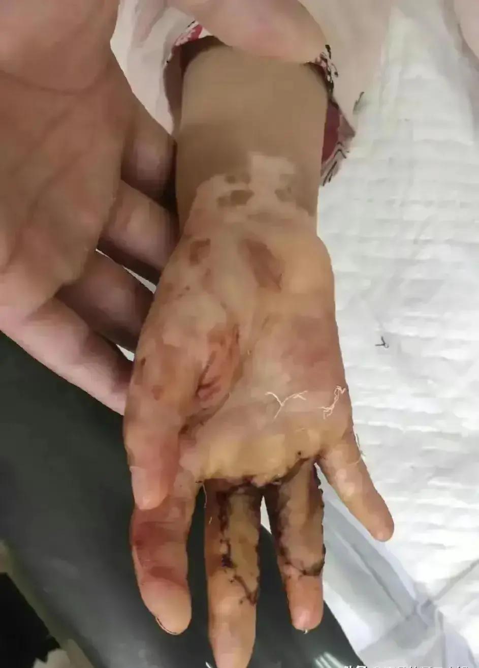 残忍的女孩遭妈妈暴打,女童遭生母残忍虐待